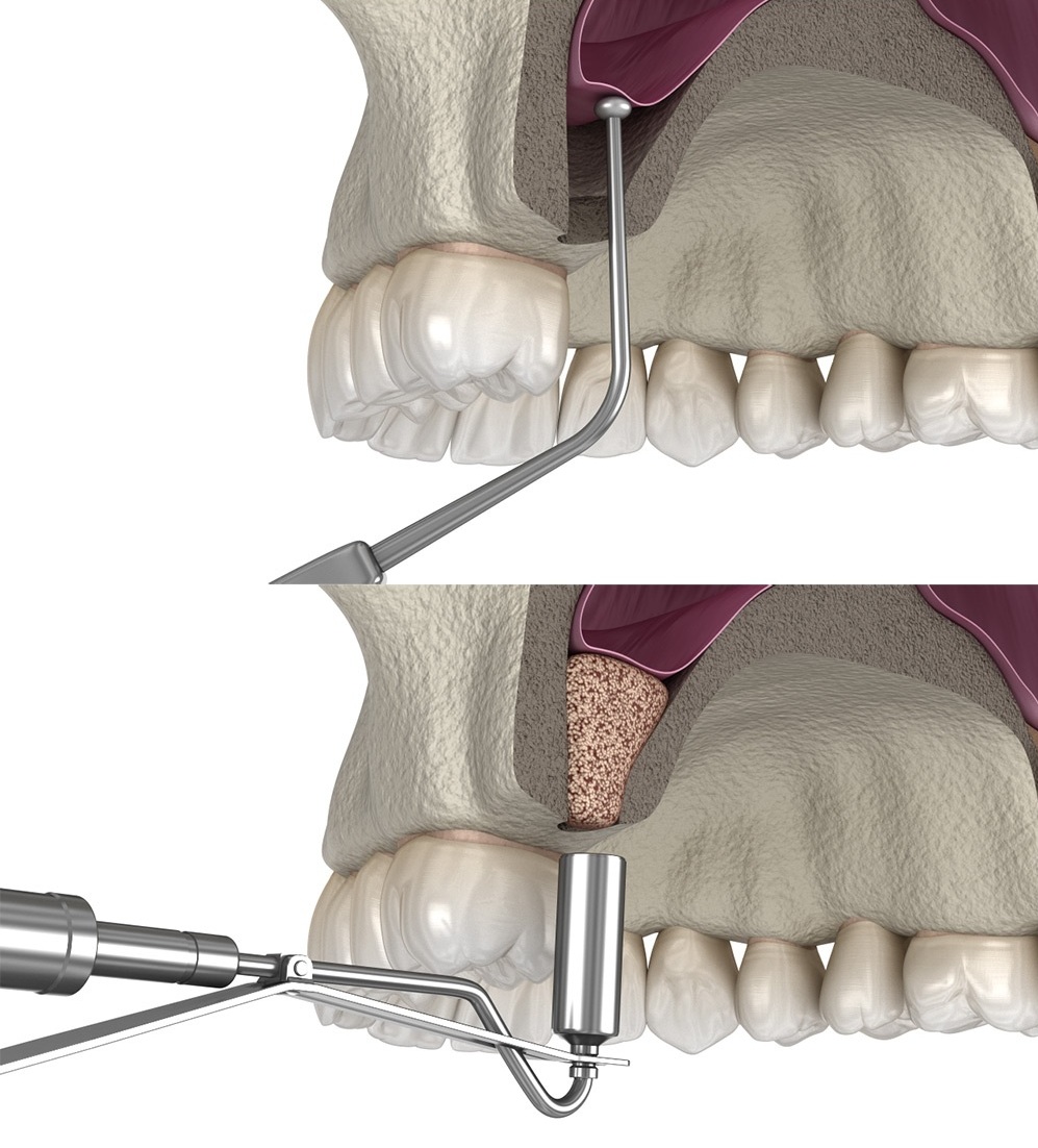 Sinus Lift  Anaheim, CA 